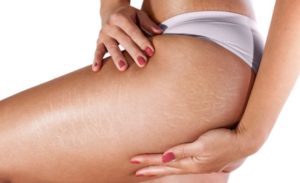Melhor Creme para estrias