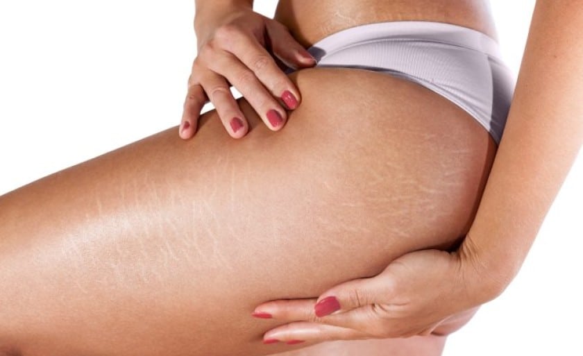 Melhor Creme para estrias